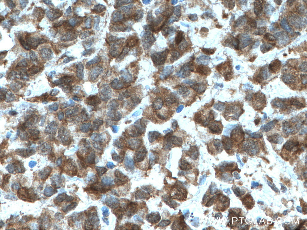 Immunohistochemistry (IHC) staining of human prostate cancer tissue using HSPA2 Monoclonal antibody (66291-1-Ig)