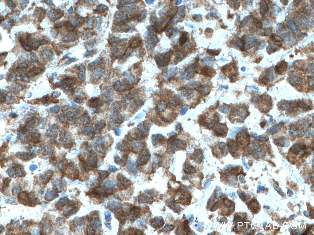 IHC staining of human prostate cancer using 66291-1-Ig