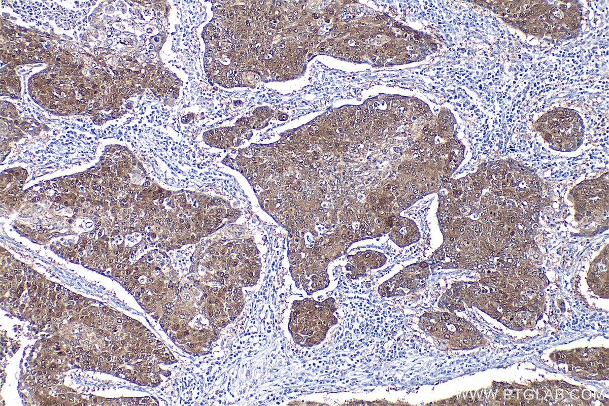 Immunohistochemistry (IHC) staining of human lung cancer tissue using HSPA4L Polyclonal antibody (32468-1-AP)