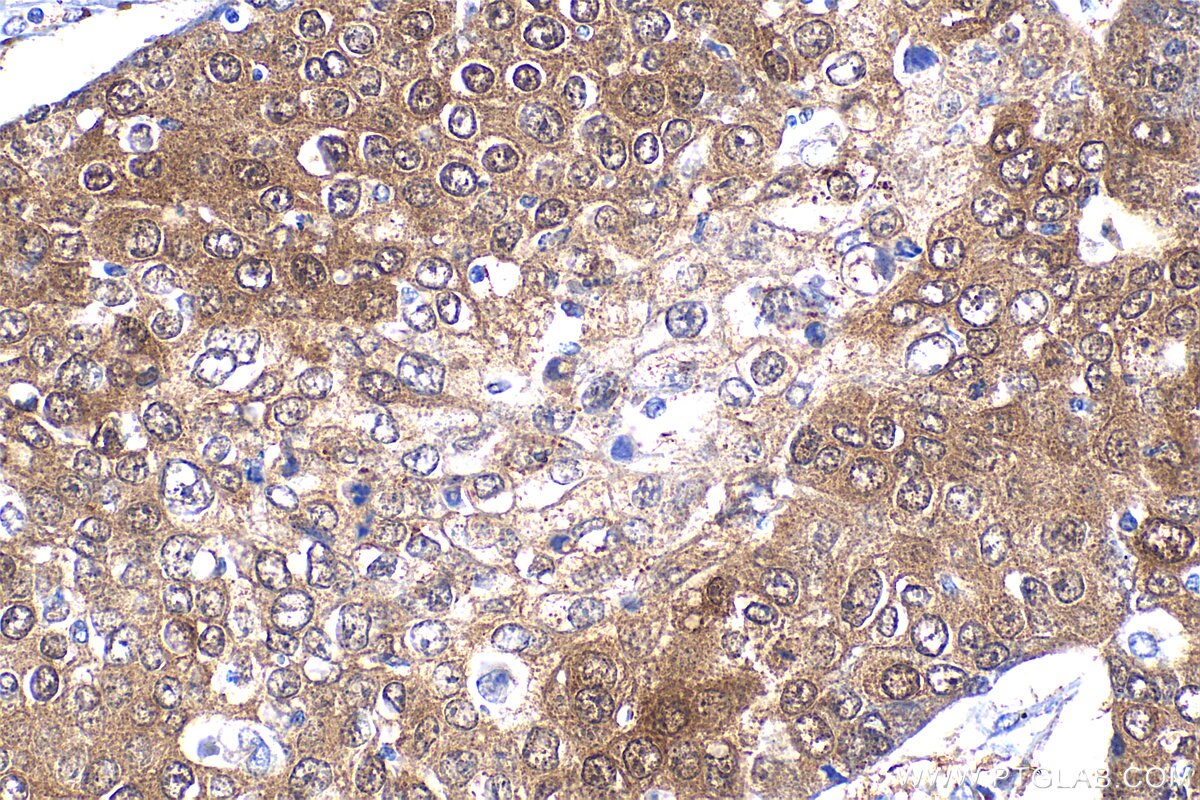 Immunohistochemistry (IHC) staining of human lung cancer tissue using HSPA4L Polyclonal antibody (32468-1-AP)