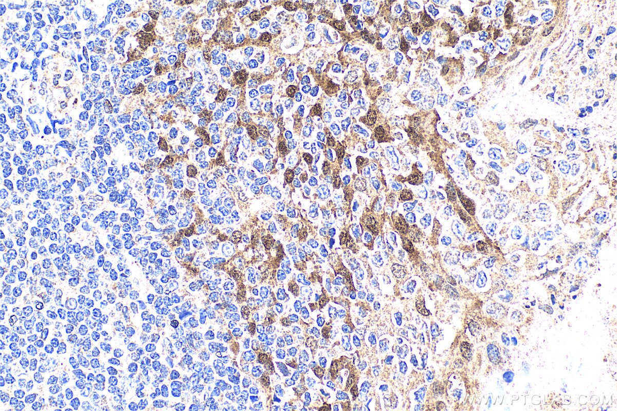 Immunohistochemistry (IHC) staining of human tonsillitis tissue using HSPA4L Polyclonal antibody (32468-1-AP)