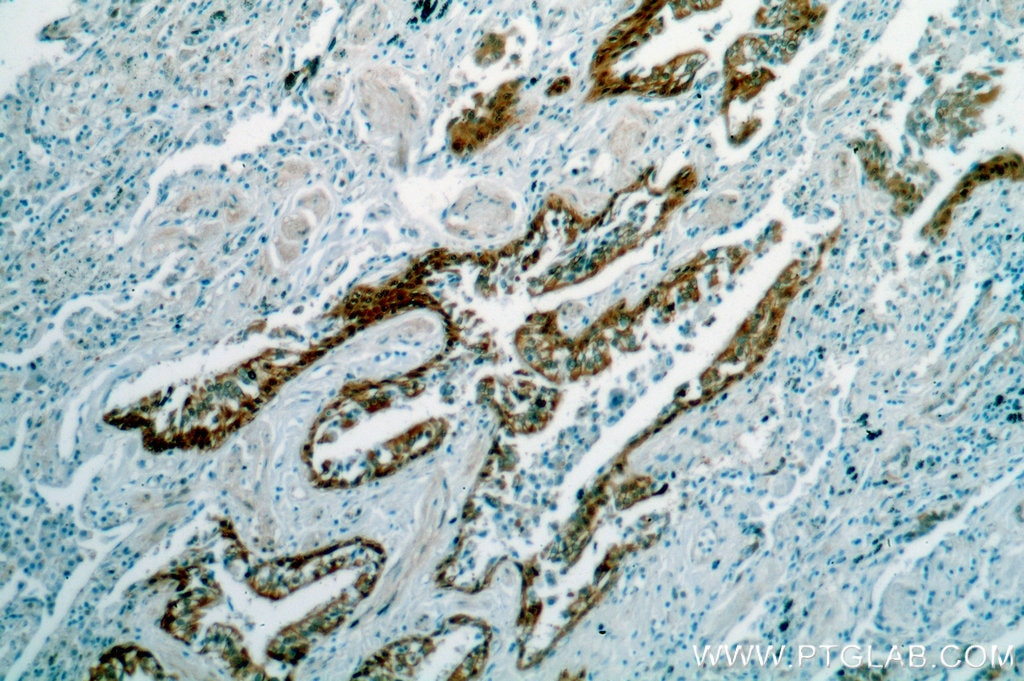 Immunohistochemistry (IHC) staining of human lung cancer tissue using HSPA6 Polyclonal antibody (13616-1-AP)