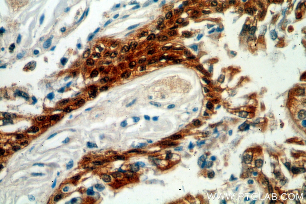 Immunohistochemistry (IHC) staining of human lung cancer tissue using HSPA6 Polyclonal antibody (13616-1-AP)