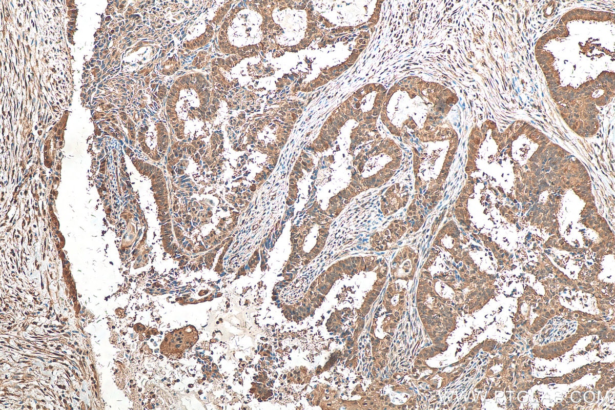 Immunohistochemistry (IHC) staining of human ovary tumor tissue using Hsc70 Polyclonal antibody (10654-1-AP)