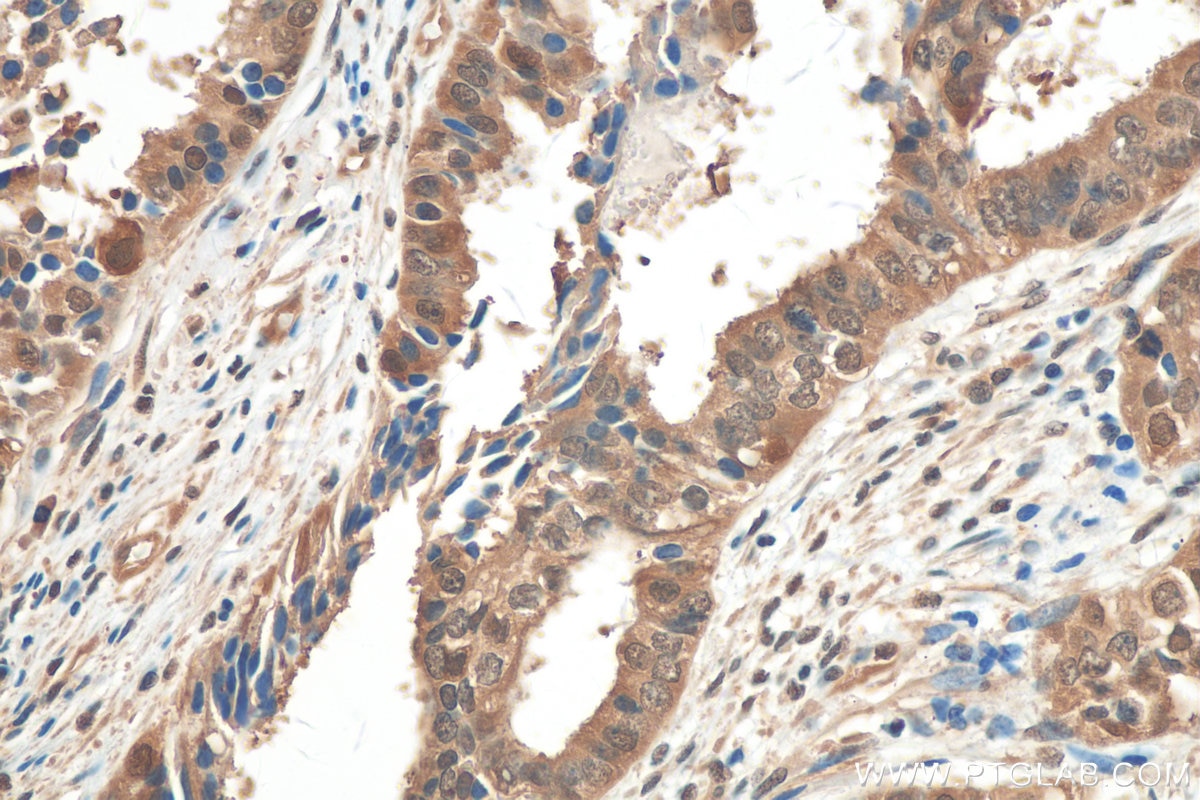 Immunohistochemistry (IHC) staining of human ovary tumor tissue using Hsc70 Polyclonal antibody (10654-1-AP)