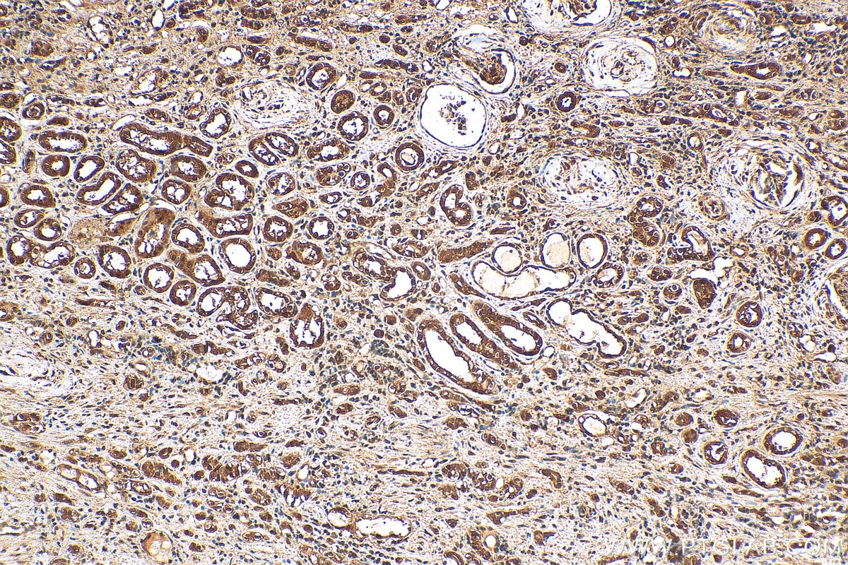 Immunohistochemistry (IHC) staining of human renal cell carcinoma tissue using Hsc70 Polyclonal antibody (10654-1-AP)