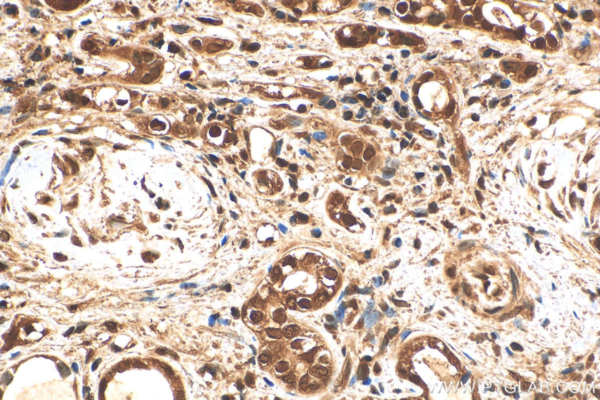 Immunohistochemistry (IHC) staining of human renal cell carcinoma tissue using Hsc70 Polyclonal antibody (10654-1-AP)
