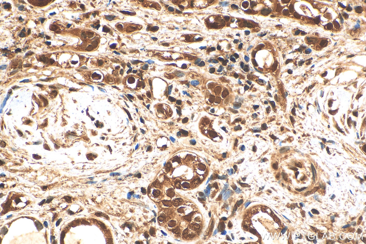 IHC staining of human renal cell carcinoma using 10654-1-AP