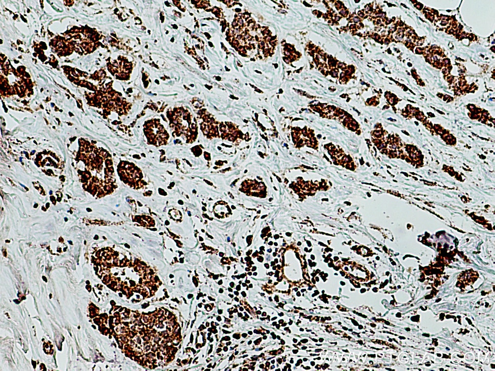 Immunohistochemistry (IHC) staining of human breast cancer tissue using GRP75 Polyclonal antibody (14887-1-AP)