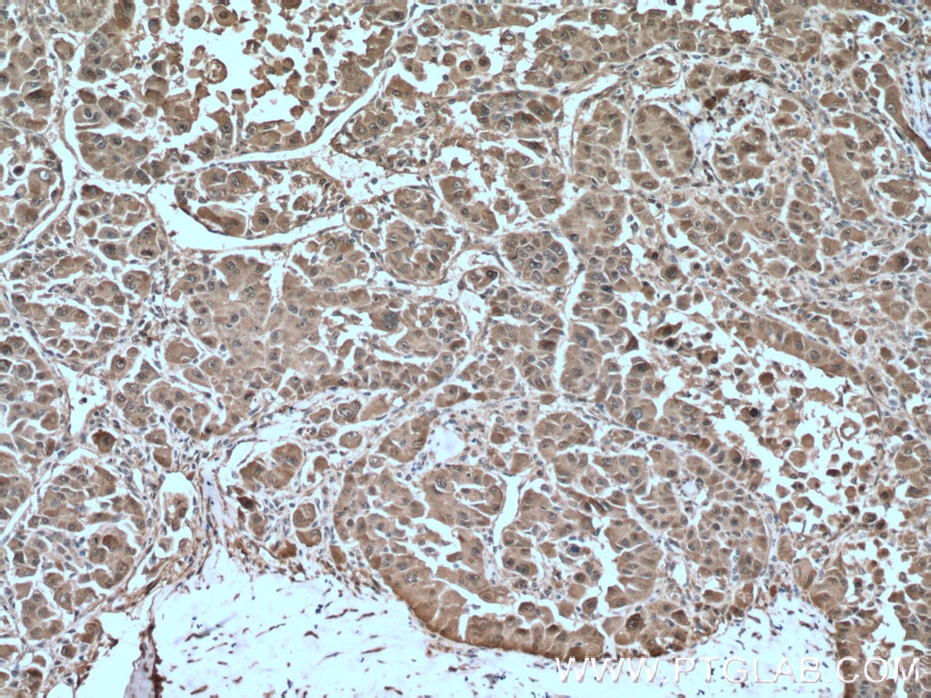 Immunohistochemistry (IHC) staining of human liver cancer tissue using HSP27 Polyclonal antibody (18284-1-AP)