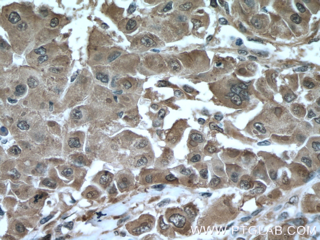 Immunohistochemistry (IHC) staining of human liver cancer tissue using HSP27 Polyclonal antibody (18284-1-AP)