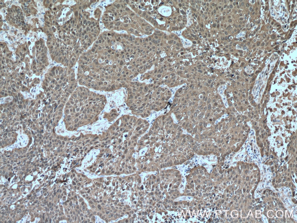 Immunohistochemistry (IHC) staining of human lung cancer tissue using HSP27 Polyclonal antibody (18284-1-AP)