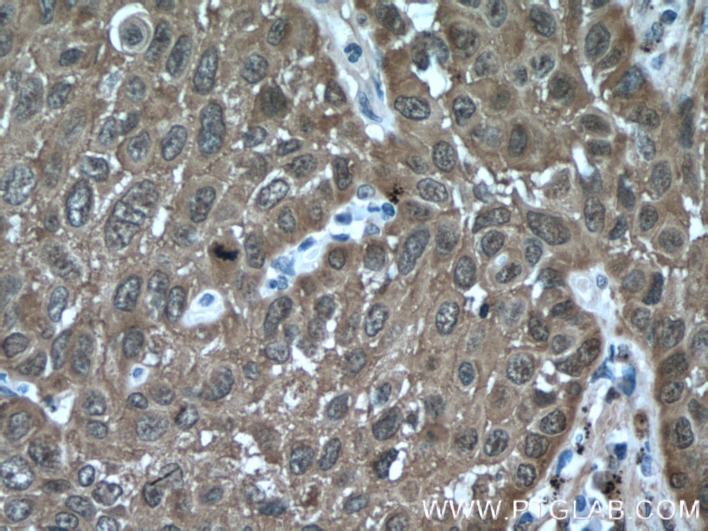 Immunohistochemistry (IHC) staining of human lung cancer tissue using HSP27 Polyclonal antibody (18284-1-AP)