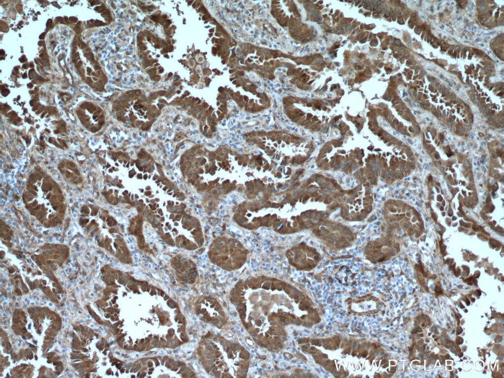 IHC staining of human lung cancer using 18284-1-AP