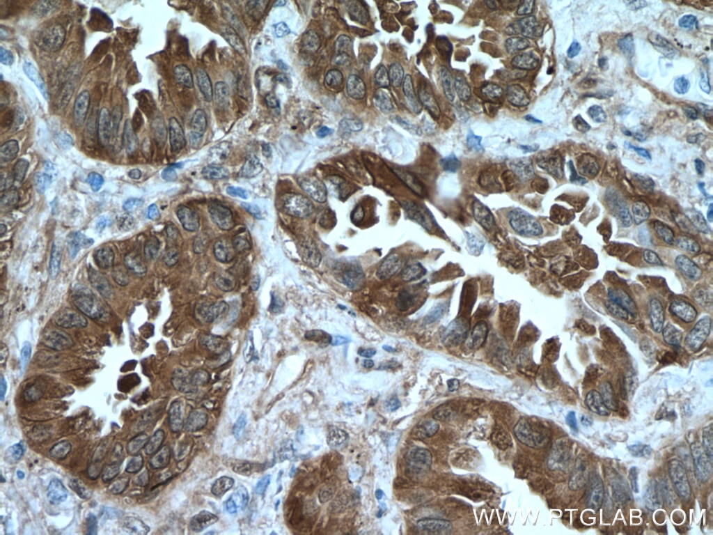 Immunohistochemistry (IHC) staining of human lung cancer tissue using HSP27 Polyclonal antibody (18284-1-AP)