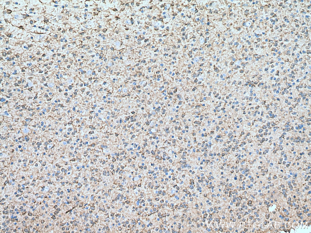 IHC staining of human gliomas using 18284-1-AP