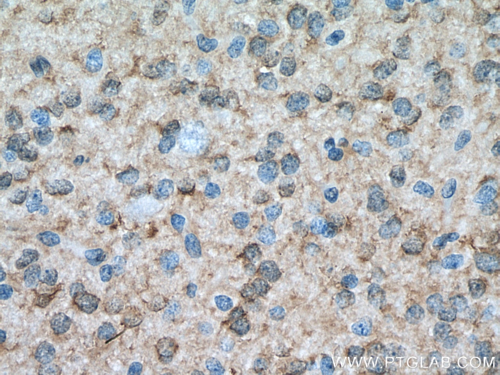 Immunohistochemistry (IHC) staining of human gliomas tissue using HSP27 Polyclonal antibody (18284-1-AP)