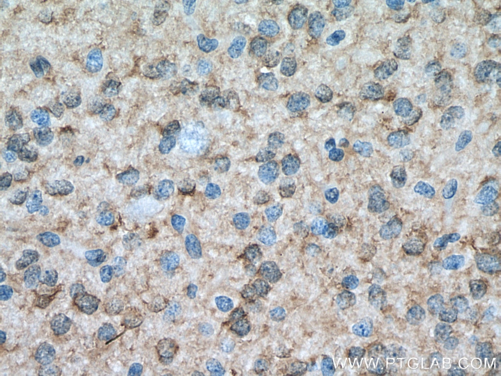 IHC staining of human gliomas using 18284-1-AP