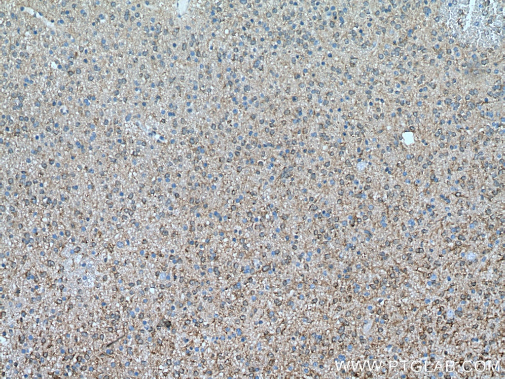 IHC staining of human gliomas using 66767-1-Ig