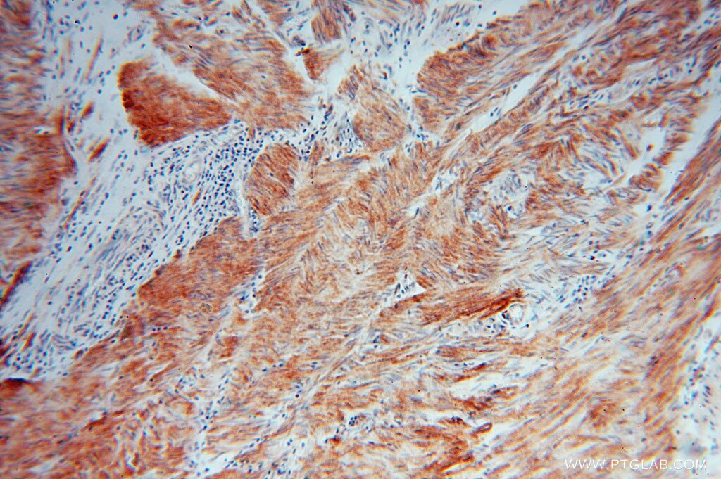 Immunohistochemistry (IHC) staining of human colon cancer tissue using HSPB7 Polyclonal antibody (15700-1-AP)