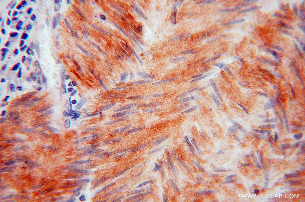 Immunohistochemistry (IHC) staining of human colon cancer tissue using HSPB7 Polyclonal antibody (15700-1-AP)