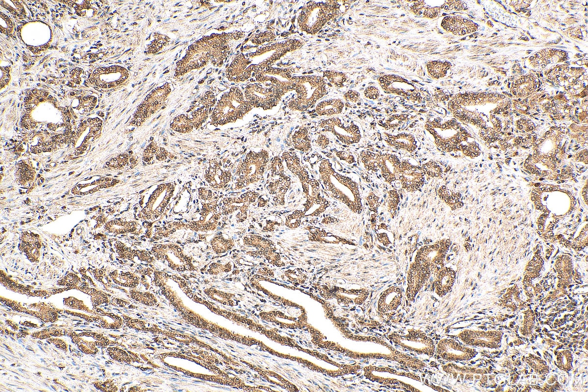 Immunohistochemistry (IHC) staining of human prostate cancer tissue using HSPBAP1 Polyclonal antibody (27631-1-AP)