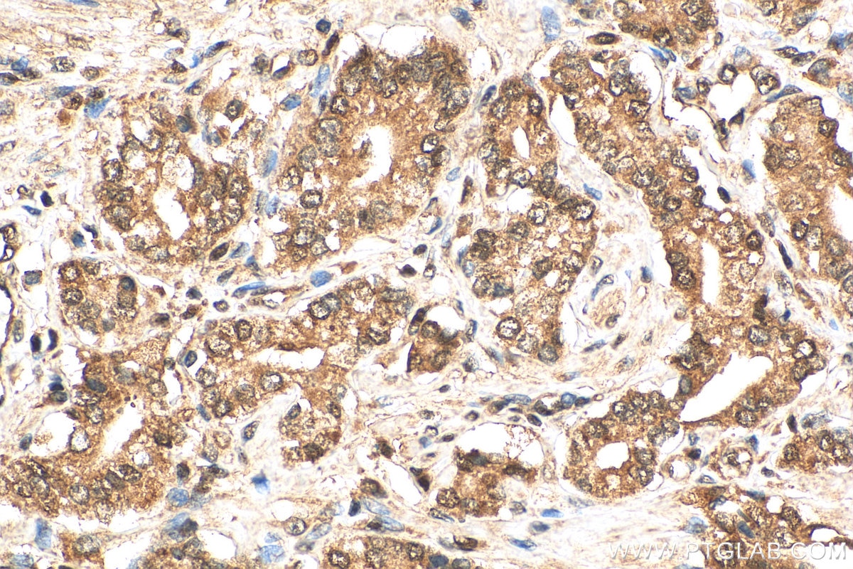 Immunohistochemistry (IHC) staining of human prostate cancer tissue using HSPBAP1 Polyclonal antibody (27631-1-AP)
