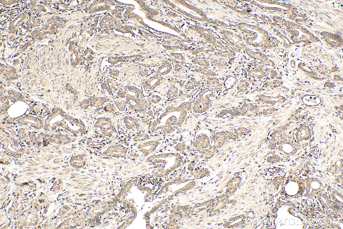 Immunohistochemistry (IHC) staining of human prostate cancer tissue using HSPBAP1 Polyclonal antibody (27771-1-AP)