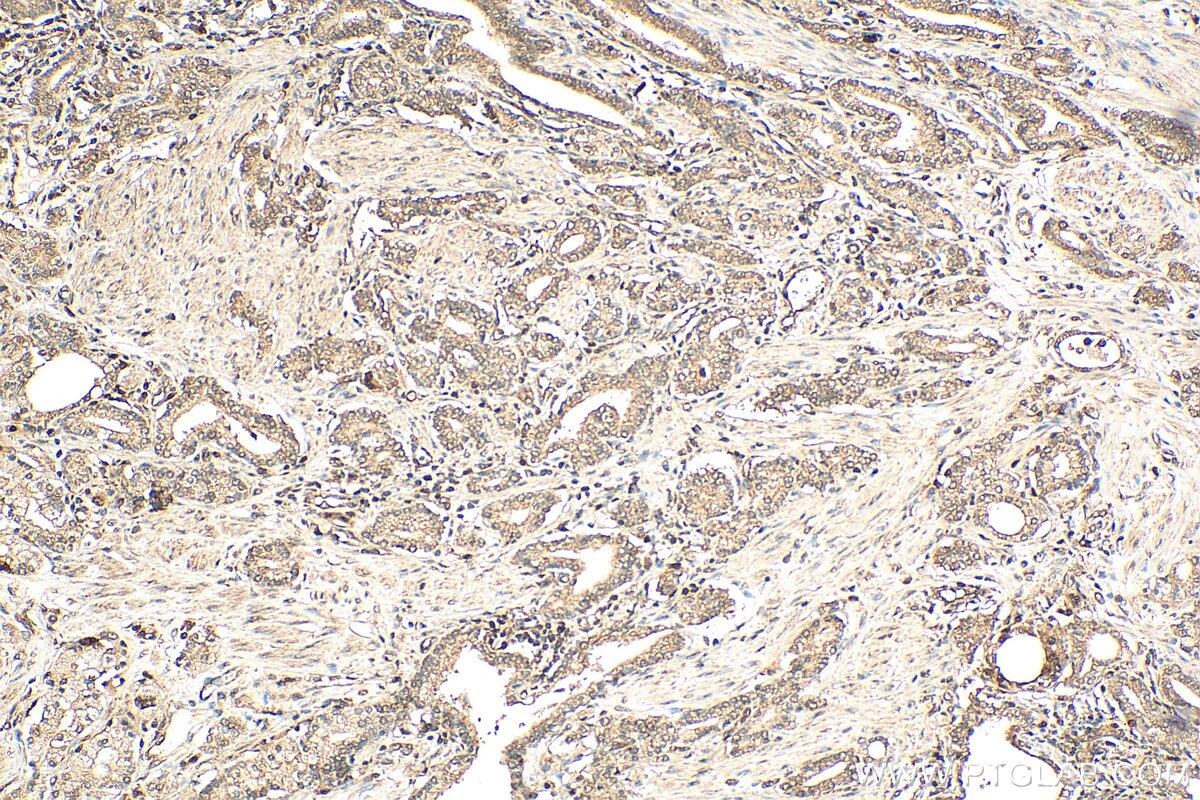 IHC staining of human prostate cancer using 27771-1-AP