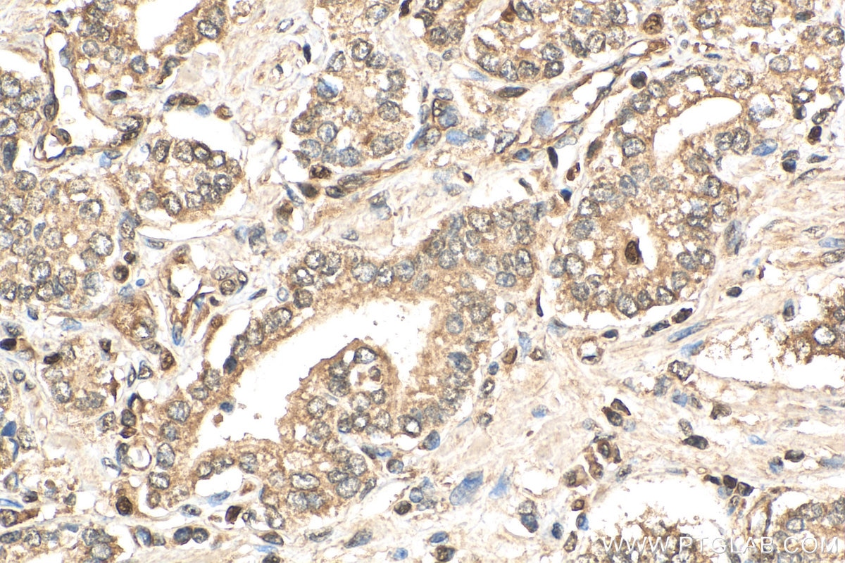 IHC staining of human prostate cancer using 27771-1-AP
