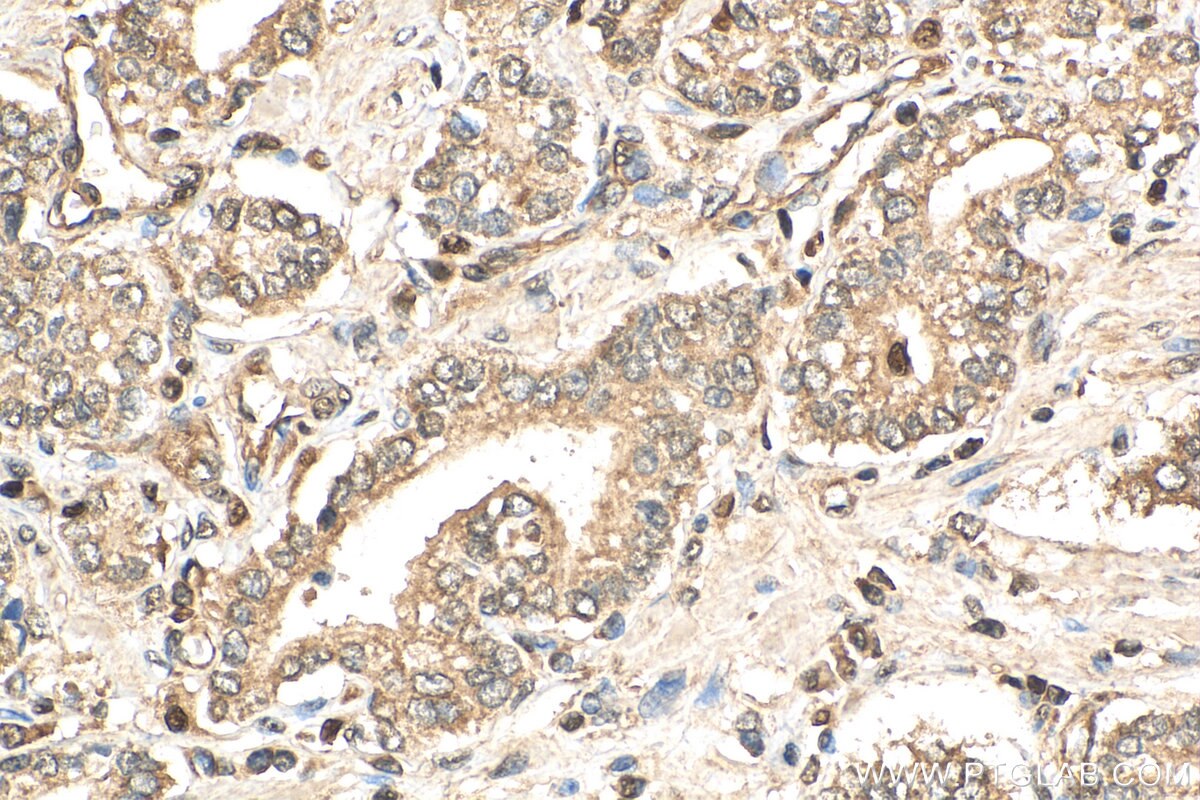 Immunohistochemistry (IHC) staining of human prostate cancer tissue using HSPBAP1 Polyclonal antibody (27771-1-AP)