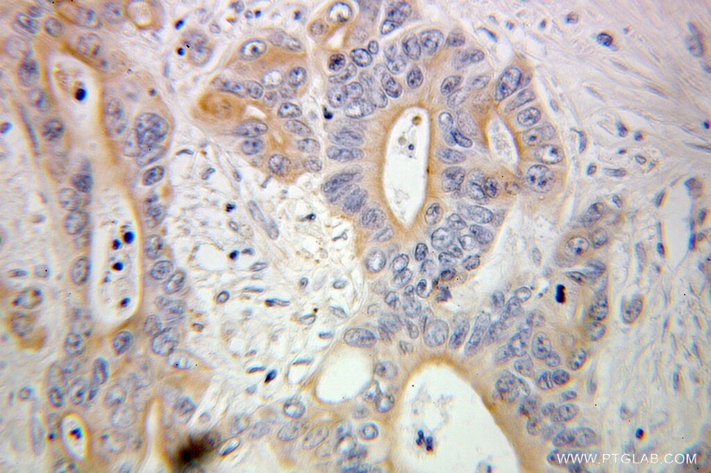 Immunohistochemistry (IHC) staining of human colon cancer tissue using HSPBP1 Polyclonal antibody (10211-1-AP)