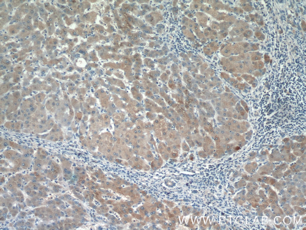Immunohistochemistry (IHC) staining of human hepatocirrhosis tissue using HSPC159 Polyclonal antibody (16708-1-AP)