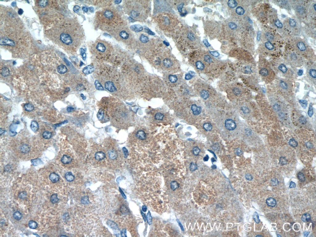 Immunohistochemistry (IHC) staining of human hepatocirrhosis tissue using HSPC159 Polyclonal antibody (16708-1-AP)