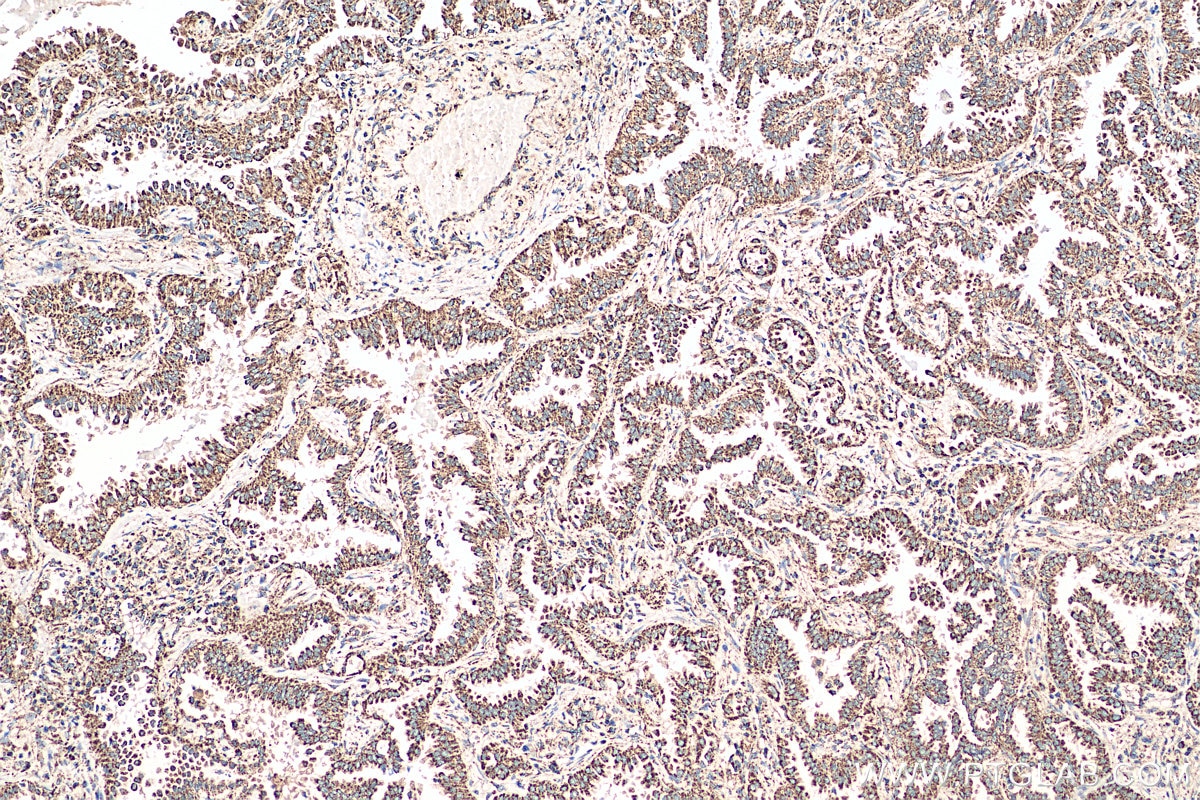 Immunohistochemistry (IHC) staining of human lung cancer tissue using HSP60 Polyclonal antibody (15282-1-AP)