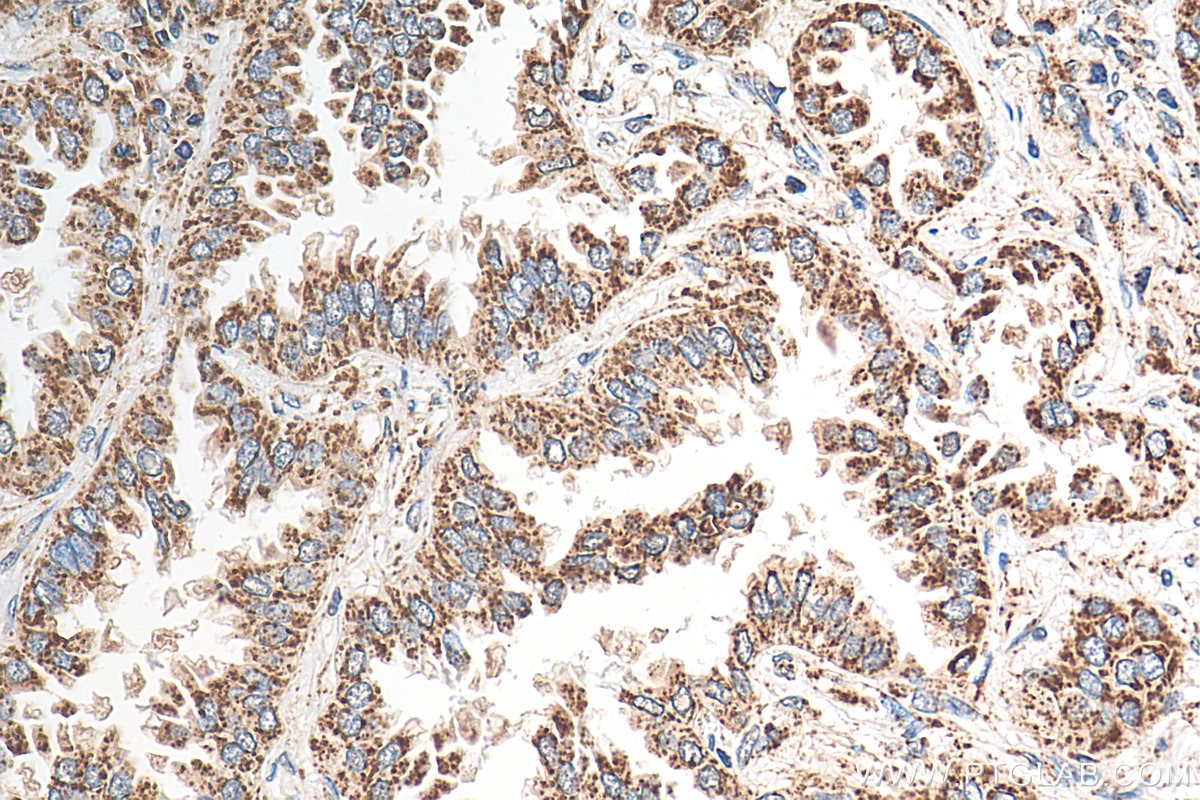 Immunohistochemistry (IHC) staining of human lung cancer tissue using HSP60 Polyclonal antibody (15282-1-AP)