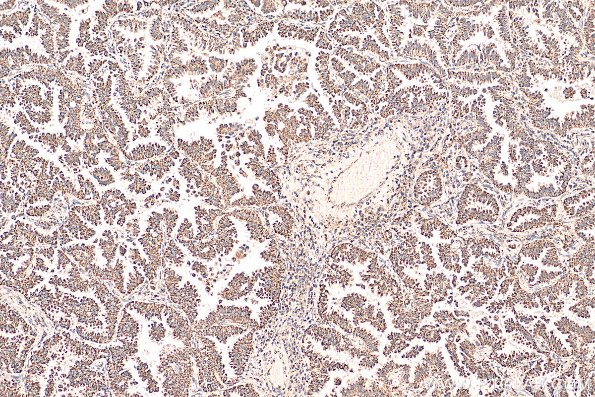 Immunohistochemistry (IHC) staining of human lung cancer tissue using HSP60 Polyclonal antibody (15282-1-AP)