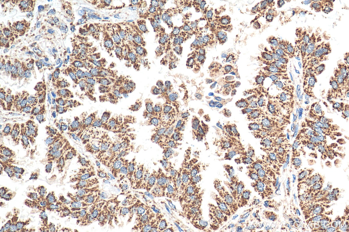 IHC staining of human lung cancer using 15282-1-AP