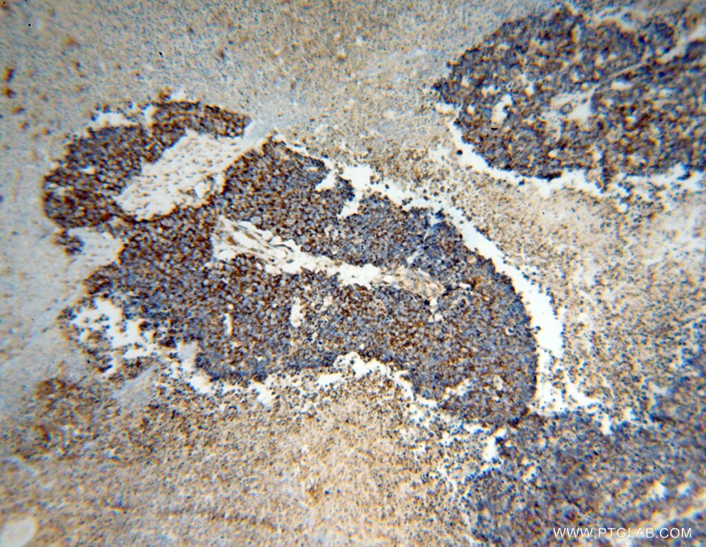 IHC staining of human lung cancer using 15282-1-AP