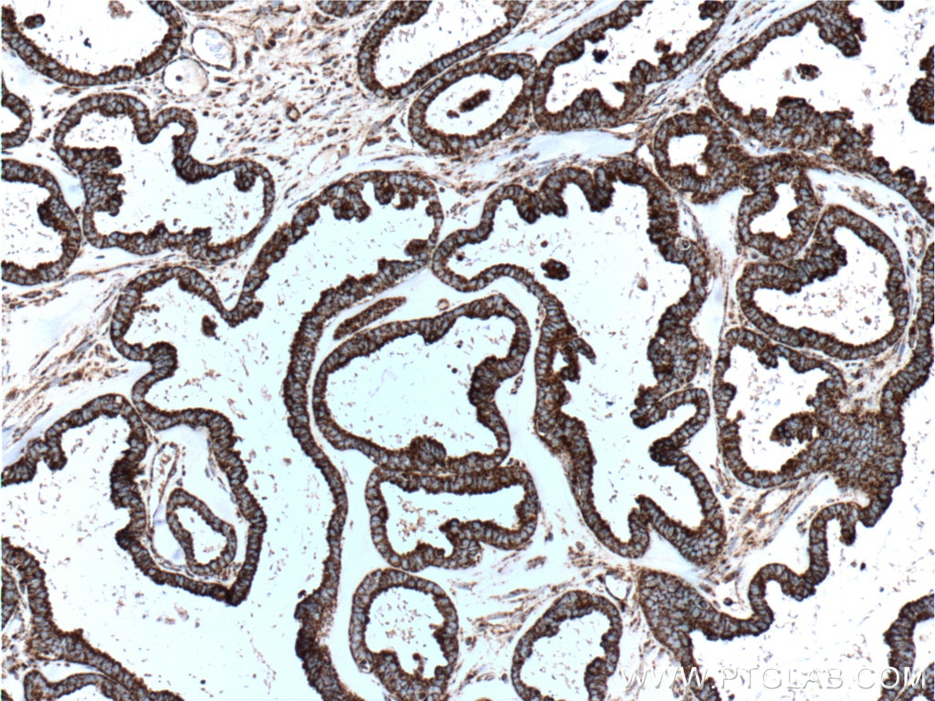 Immunohistochemistry (IHC) staining of human ovary tumor tissue using HSP60 Monoclonal antibody (66041-1-Ig)