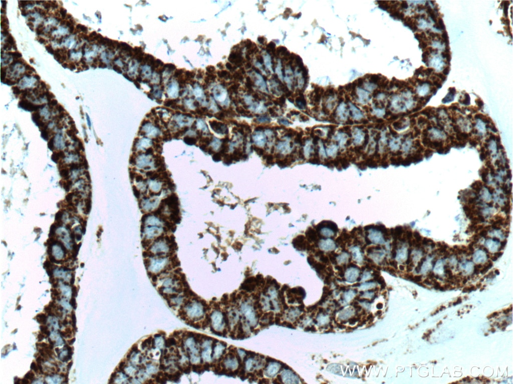 Immunohistochemistry (IHC) staining of human ovary tumor tissue using HSP60 Monoclonal antibody (66041-1-Ig)