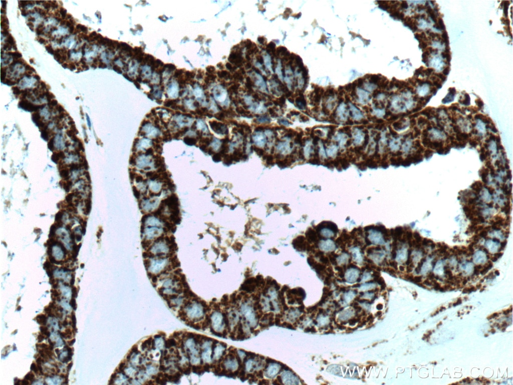 IHC staining of human ovary tumor using 66041-1-Ig