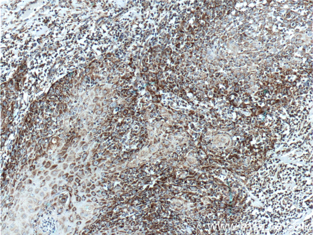 Immunohistochemistry (IHC) staining of human skin cancer tissue using HSP60 Monoclonal antibody (66041-1-Ig)