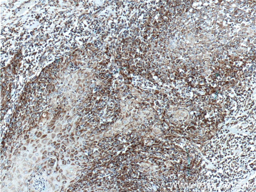 IHC staining of human skin cancer using 66041-1-Ig