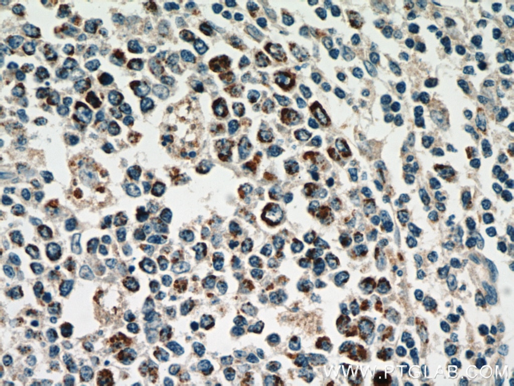 IHC staining of human tonsillitis using 66041-1-Ig