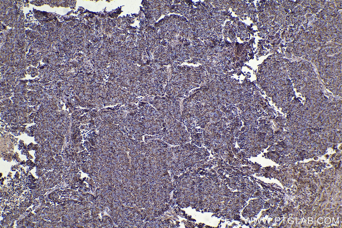 Immunohistochemistry (IHC) staining of human lung cancer tissue using HSP10 Polyclonal antibody (16512-1-AP)