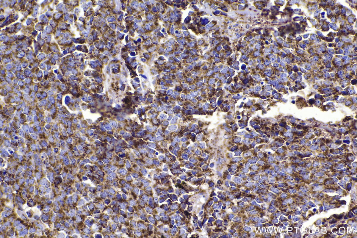 Immunohistochemistry (IHC) staining of human lung cancer tissue using HSP10 Polyclonal antibody (16512-1-AP)