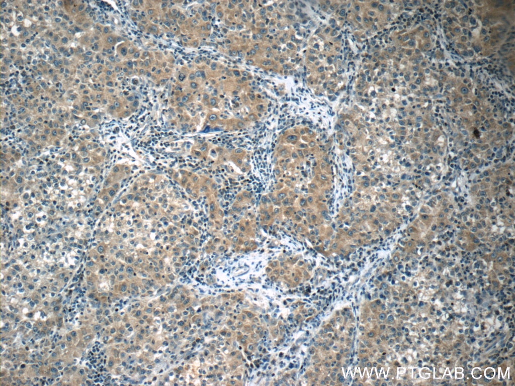 Immunohistochemistry (IHC) staining of human liver cancer tissue using HSPH1 Polyclonal antibody (13383-1-AP)