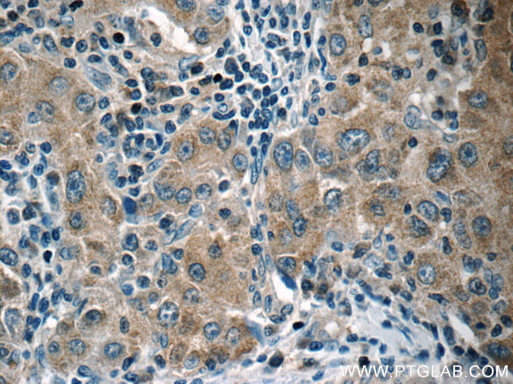 IHC staining of human liver cancer using 13383-1-AP