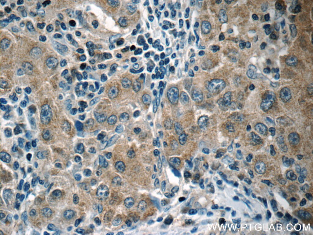 Immunohistochemistry (IHC) staining of human liver cancer tissue using HSPH1 Polyclonal antibody (13383-1-AP)